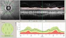 Noninvasive mapping of the normal retinal thickness at the posterior pole.
