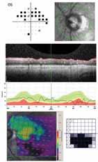 Improved macular thickness?