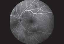 Fluorescein Angiogram 25 IOPs after SLT OS 20 Slight delay in filling inferiorly 15 10 Pre-laser Diurnal Curve Right eye 5 0 8:00 9:00 10:00 11:00 12:00 1:00 2:00 3:00 4:00 Summary of Follow-up