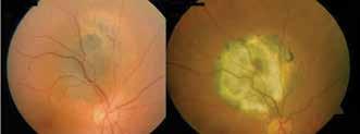 Tarlan and Kıratlı, Uveal Melanoma In the COMS, tumors with thickness less than 3 mm and basal diameter up to 16 mm tumors were classified as small melanomas, and 204 choroidal melanoma cases were