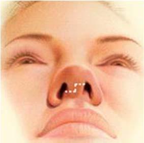 Nose surgery to improve an obstructed airway requires careful evaluation of the nasal structure as it relates to airflow and breathing.