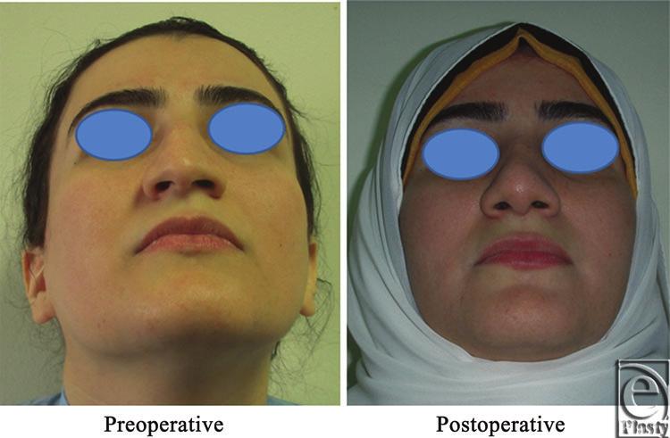 shape of the nose before and after Skin thickness was N + 1.