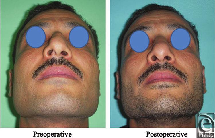 the shape of the nose before and after Skin thickness was N + 1.