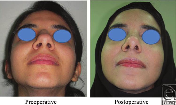 shape of the nose before and after Skin thickness was N + 2 and