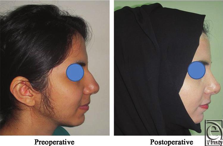 before and after open primary rhinoplasty. Figure 7.