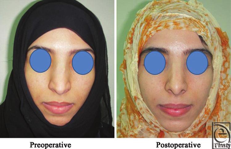 eplasty VOLUME 13 Figure 8. A front view photo for a 29-year-old female patient shows the shape of the nose before and after Skin thickness was N + 1. Figure 9.