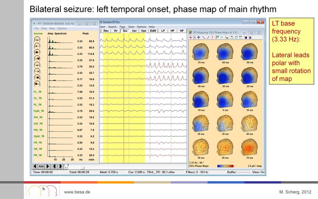 In this seizure involving bilateral temporal cortex, we will analyze the different base rhythms near onset both in the left and right hemispheres as well as the first harmonic (at twice the base