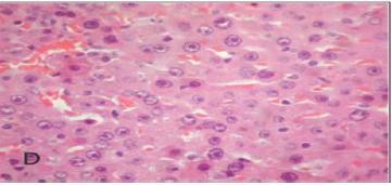 Figure (2) D) Female rat liver administered for 14 months (600 ppm), showing dysplastic changes