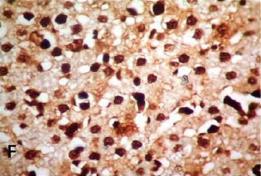 PCNA immuno-reactivity F) Rat liver after 14 months showing strong intensity