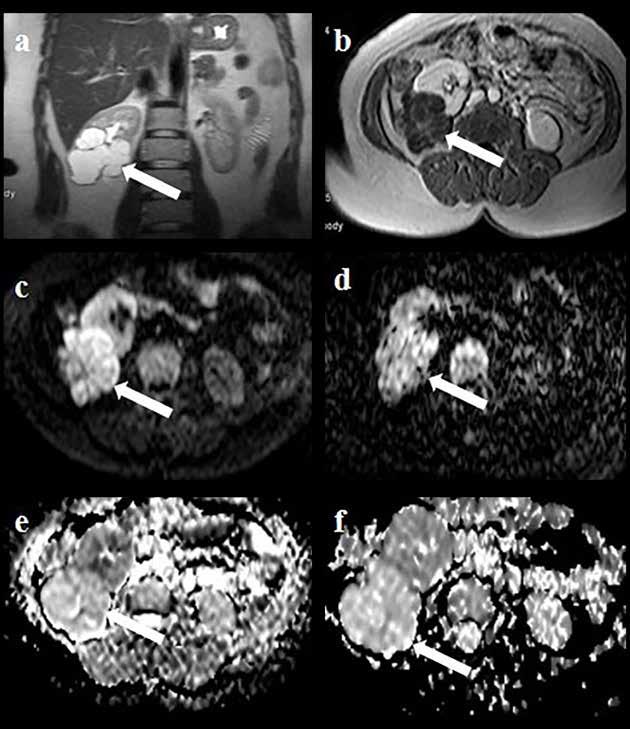 Original Article Pol J Radiol, 2017; 82: 209-215 A B C D E F Figure 2. A 38-year-old woman with cystic renal cell carcinoma in the right kidney. (A) T2-weighted coronal image shows a cystic mass.