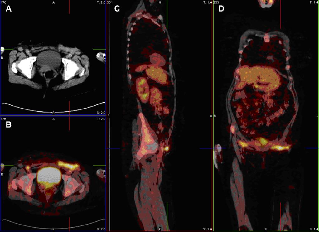 FDG-PET and FDG-PET/CT for Diagnosing Vascular Graft Infections 41 the left external iliac artery, for which a percutaneous transluminal angioplasty (PTA) and stent placement was performed.