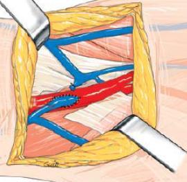 BVTS : 1 st stage A side-to-end anastomosis is created between the brachial artery and the median antecubital vein.