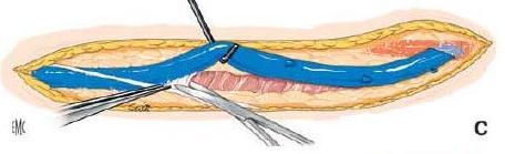 BVTS : 2nd stage A longitudinal skin incision is made along the medial upper arm.
