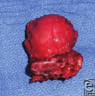 eplasty VOLUME 13 METHODS/CASE PRESENTATION An Asian female, age 17 months, was diagnosed with a yolk sac tumor after biopsy of a mass emanating from the sacrum and extending into the buttocks.