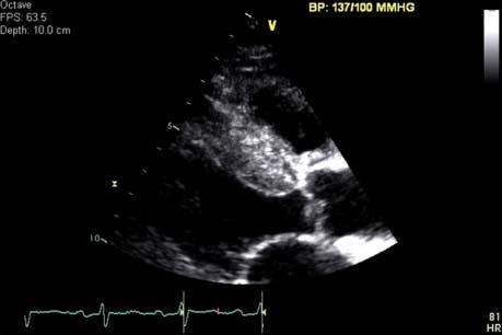 Video 2 Parasternal long-axis clip magniﬁed to illustrate the interventricular septum. This clip clearly demonstrates the echo-bright myocardium of the septum in a speckled pattern.