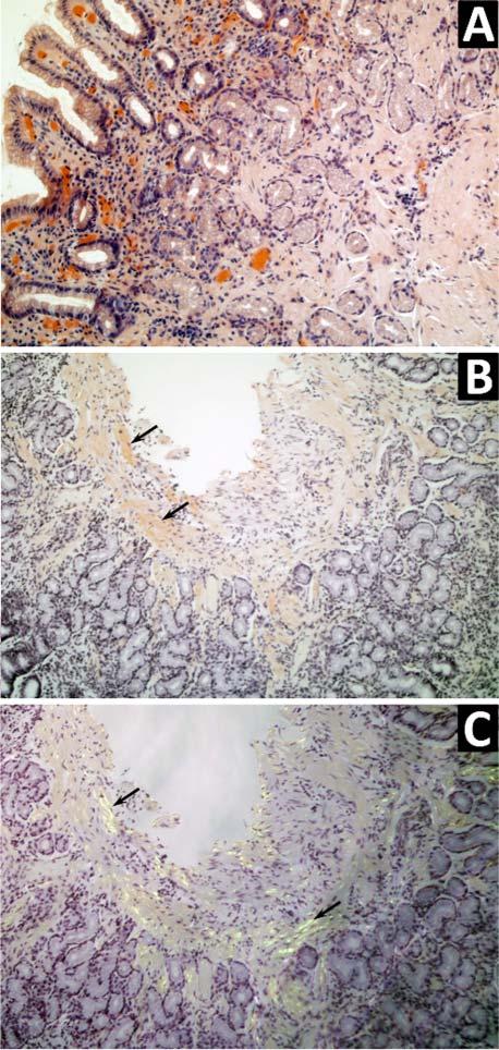 Figure 5 Gastric biopsy pathology slides (A) H&E. (B) Amorphous submucosal deposits of amyloid detected with Congo red stain.
