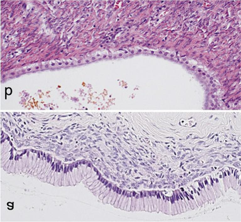 Figure 1. Histology of the lining epithelium of mucinous cystic neoplasms (HE, 400). a: Mucinous epithelium; tall columnar epithelium with abundant mucinous cytoplasm.