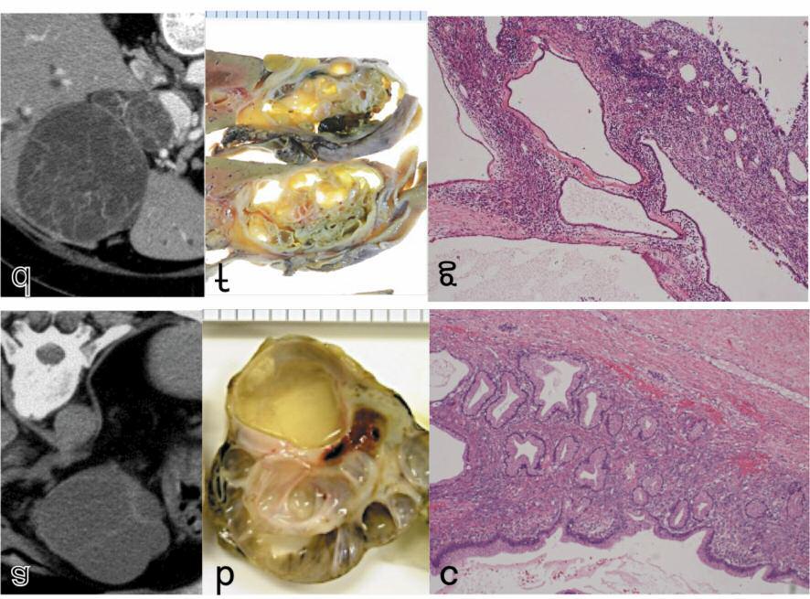 Figure 2. Computed tomography (a, d) and pathological findings (b, c, f, g) of two cases of mucinous cystic neoplasms (MCN) with low-grade dysplasia.