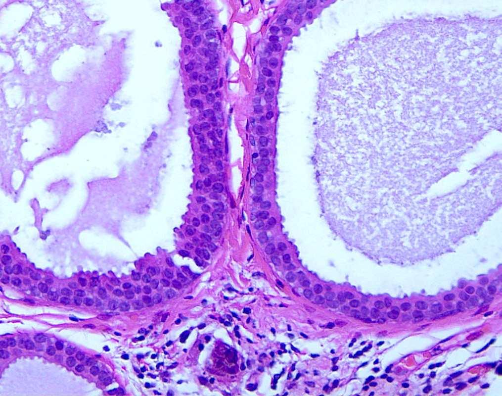 Cell Hyperplasia Irregular