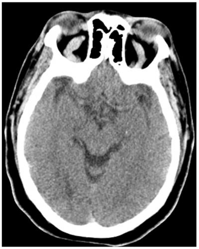 Figure 1 Axial non contrast head CT shows enlarged