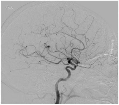 Enlargement of the superior ophthalmic vein may be seen in carotid cavernous fistula, cavernous thrombosis, Graves orbitopathy, orbital pseudotumor, and parasellar tumors, orbital varices and