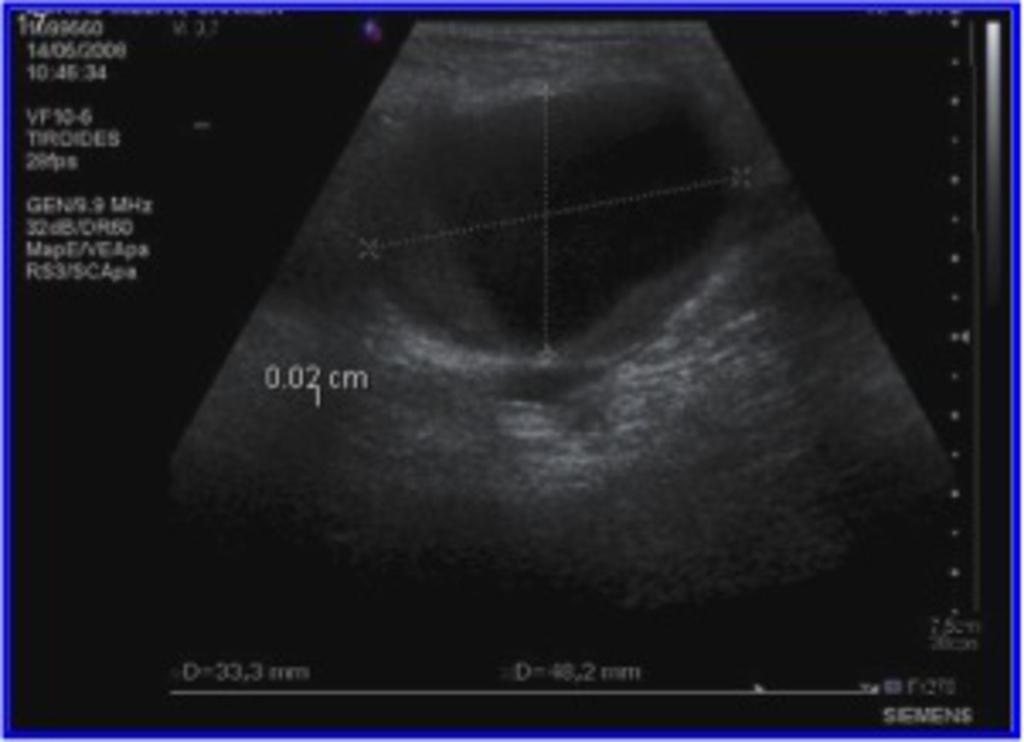 Fig. 15: Gray Scale pseudoaneurism