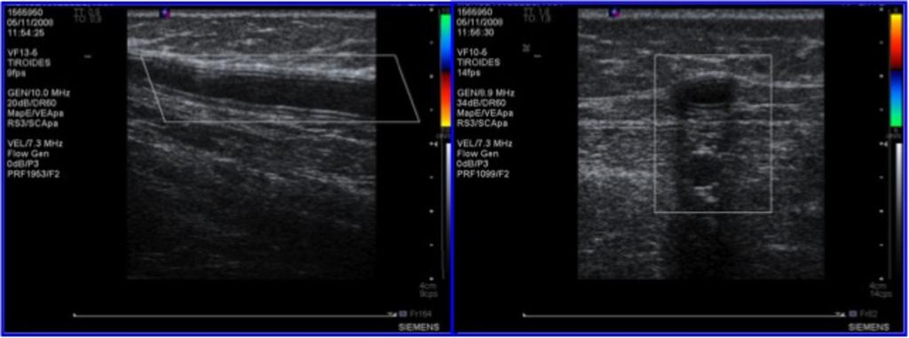 Fig. 26: Control ultrasound patient with By-Pass thrombosed