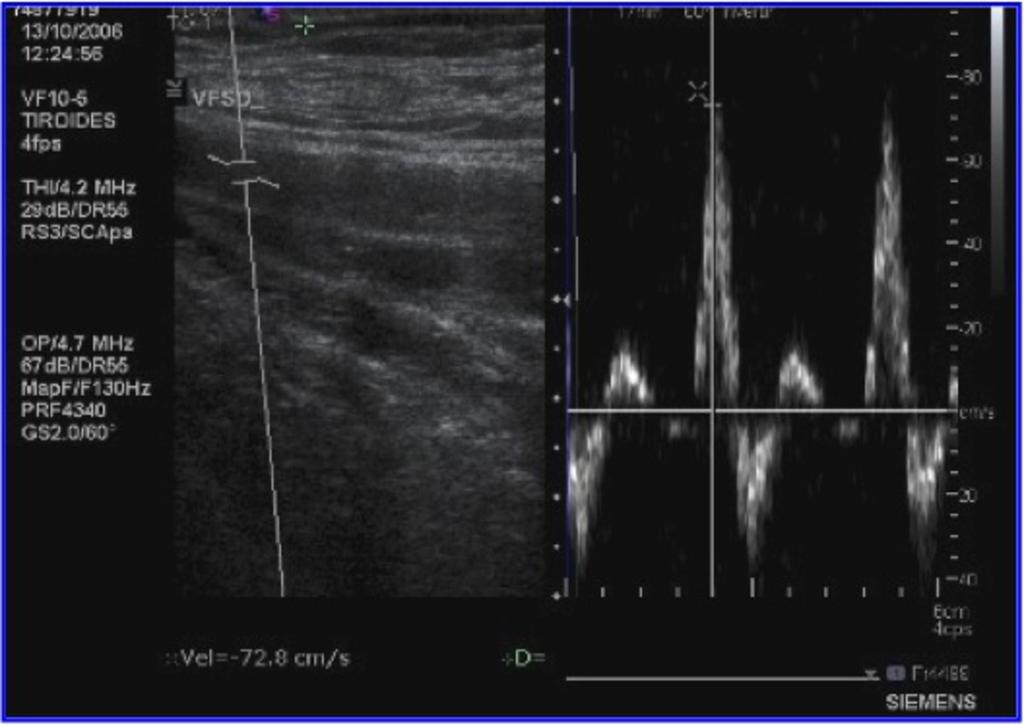 Fig. 3: Ultrasound dupplex: simultaneous exposure