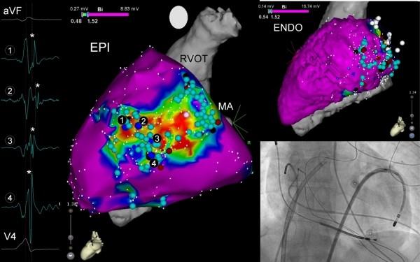 Neven K et al, Prevention of Phrenic Nerve Damage by Pericardial Saline Injection 90 Figure 2. Electroanatomic maps and fluoroscopy of first patient.