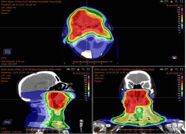 including dosevolume effects can include all types of data without knowing how the variables are related Radiotherapy planning