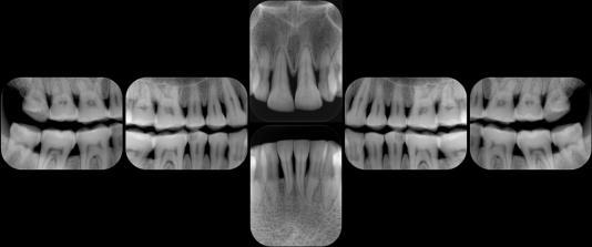 ID Name DENTAL IMAGE LAYOUT S009A 2 standard +4 bitewing layout