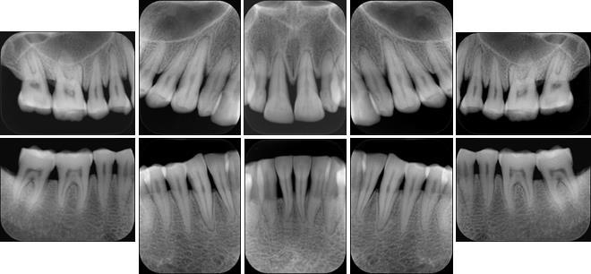 Table 1 - DENTAL IMAGE LAYOUT ID Name DENTAL IMAGE LAYOUT S0A standard layout A 00 PA STD 02 03 04 12 13 14 S0A: 00 17, 16, 15 NONE