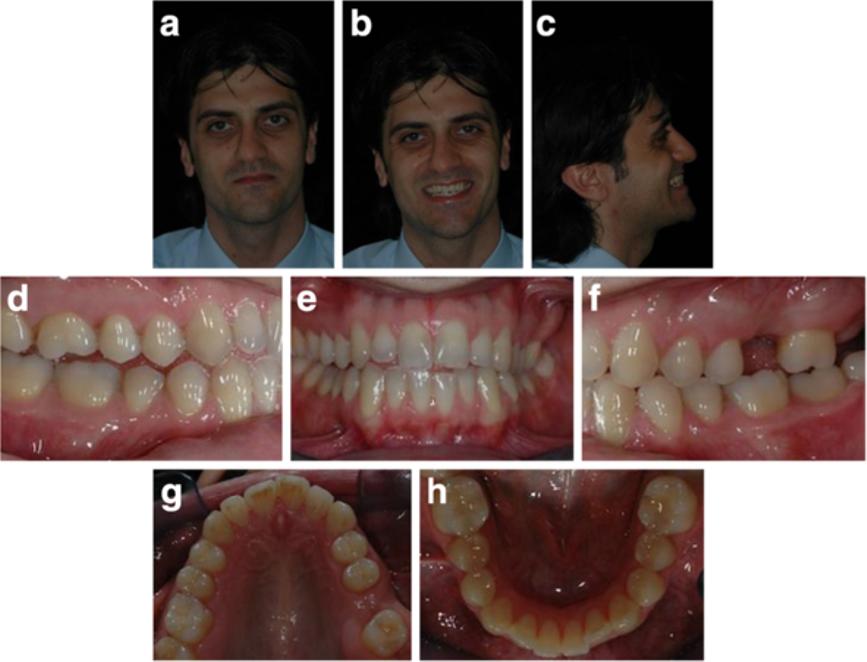 Mampieri and Giancotti Progress in Orthodontics 2013, 14:40 Page 2 of 9 Figure 1 Pre-treatment records (a to h). The treatment plan concerning the upper arch was the intrusion of 1.