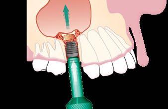 0mm Introduce the implant into the osteotomy site with the implant inserter and use the implant to raise the sinus floor.