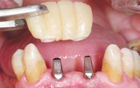 Snap the completed transitional prosthesis onto the abutment to facilitate the