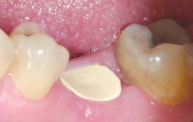 the gingival sulcus. The abutment may be modified to achieve the desired contour.