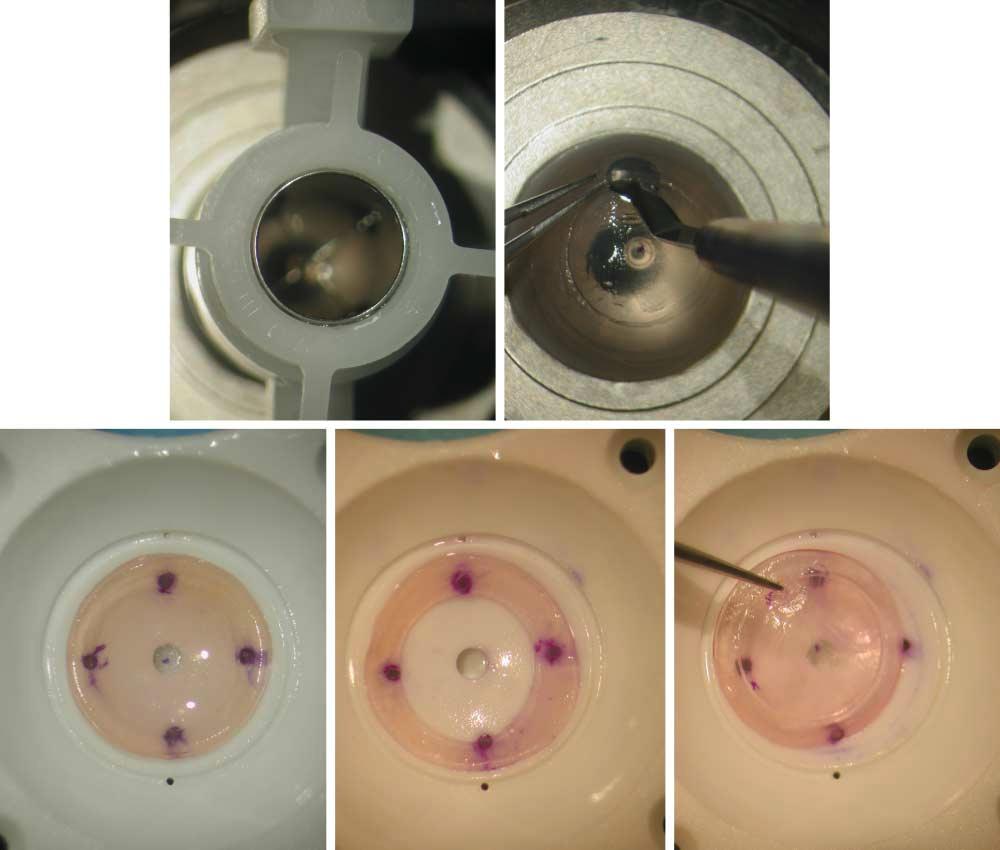 A B C D E Figure 2. Preparation of the donor button. A, Partial trephination of the donor cornea mounted on the artificial chamber.