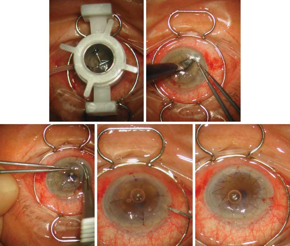 A B C D E Figure 3. Main surgical steps of the nut-and-bolt keratoplasty procedure. A, Partial trephination of the recipient bed, 7.0 mm in diameter (same as for the donor cornea) and 0.3 mm in depth.