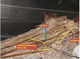 Method The study of variations in branching pattern of MCN has been observed during routine educational dissection done in the Department of Anatomy, Superior extremities of 25 cadavers, 50 Limbs,