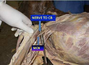 MCN despite of piercing coracobrachialis muscle gave the 1 st branch to coracobrachialis near corocoid process, the 2 nd branch to Biceps Brachii (BB) almost at the mid of the arm and gave the 3 rd