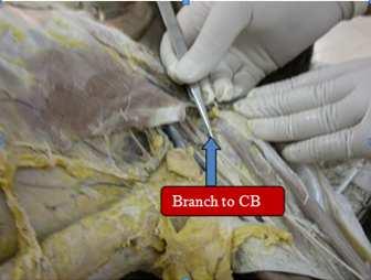 , 2006 [8] reported that in one limb, the MCN had a low origin and that the nerve was found not piercing the coracobrachialis, similar finding we also observed in our case [Figure 5a]. The Chitra R.