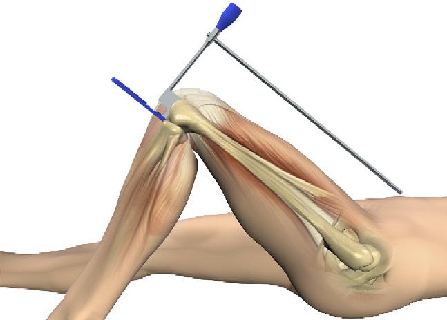 N.P. Kort et al. / The Knee 14 (2007) 280 283 283 Fig. 5. By adjusting the degree of flexion of the knee, the extramedullary rod is made to lie parallel with the femur when viewed from the side.
