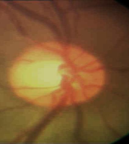 Optic Disc : Comparison RE LE Bayoneting Sign Deep cupping of optic disc with CDR 0.9:1 Figure 4.