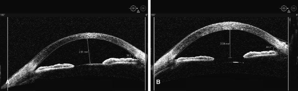 Dawczynski et al Fig. 1-58-year-old woman, no known glaucoma. (A) Preoperative anterior segment optical coherence tomography (OCT) (lens thickness 4.