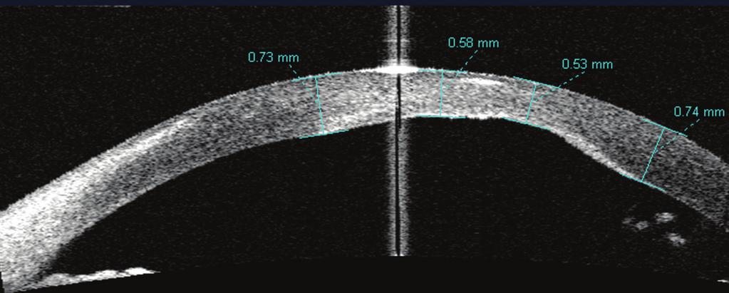 Note a circular structure in the anterior chamber correspondent to a transverse section of a glaucoma drainage tube.