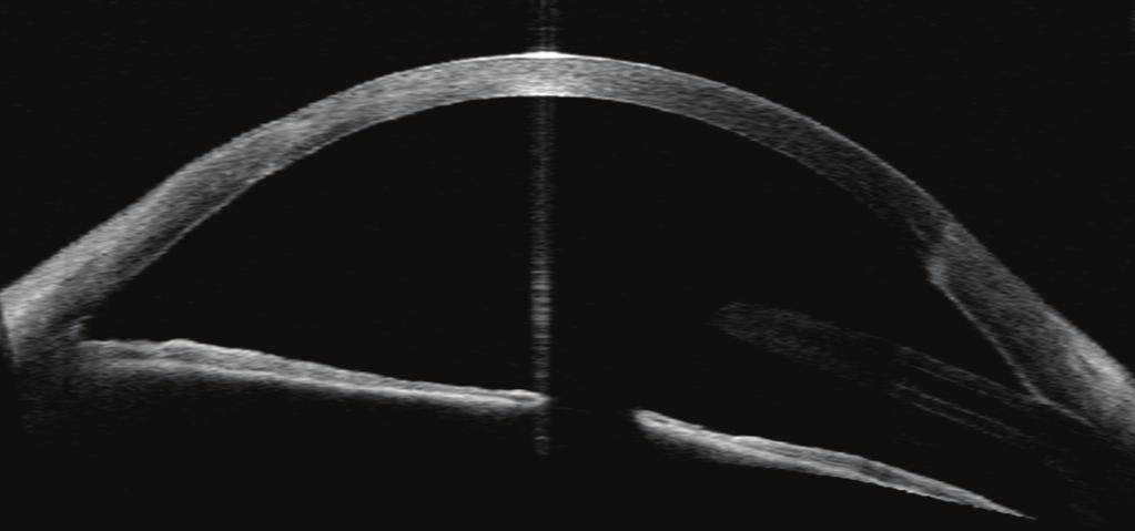 Donor-recipient junction and an inferonasal glaucoma drainage tube, apparently touching the cornea, that presents local edema (right side).