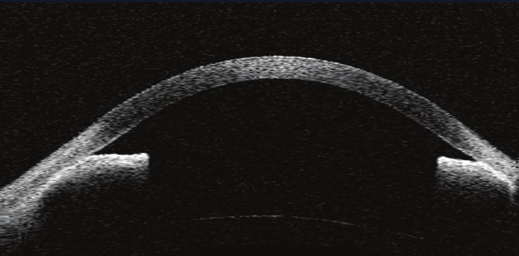 High frequency ultrasound (UBM) of the same eye after implantation of glaucoma drainage tube, showing the tube in the anterior chamber, an irregular and hyperrefletive lens and angle closure at the
