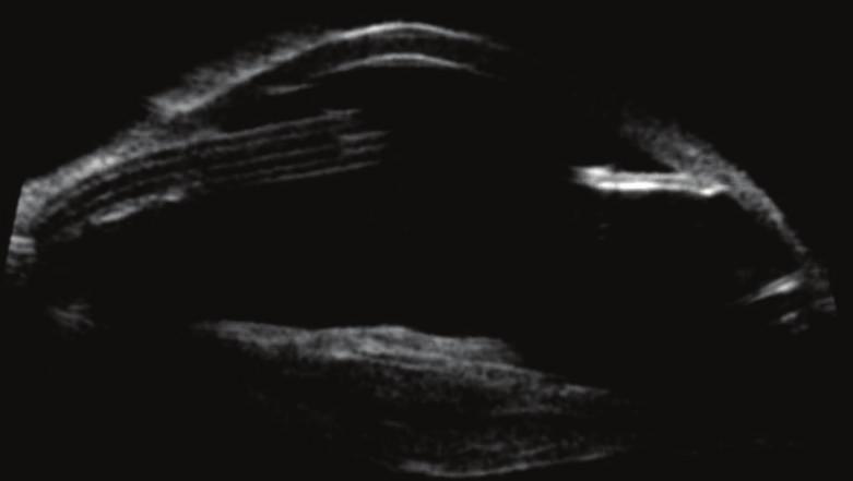 the pachymetric map objectively measuring and localizing corneal thinning (352 microns, Figure 1(c)).