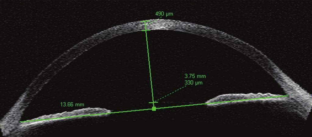 Mesoectodermal dysgenesis (as Peters syndrome, 2 eyes) demonstrated increased reflectivity of the central cornea (leukoma) associated with local indentation (malformation) of the posterior surface