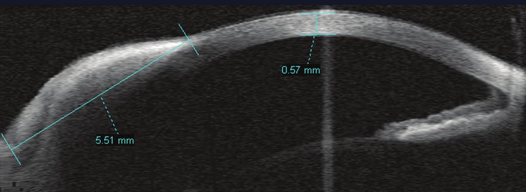 Findings of decreased anterior chamber depth and peripheral synechiae were associated (n = 2 eyes). 3.4. Application of AS-OCT in Evaluating the AC Angle.